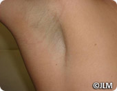 Axillary node dissection