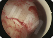 Myomectomy techniques