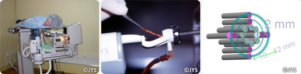 Stereotactic (Mammotome®) Macro biopsy