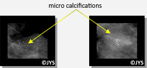 How does a mammogram work?